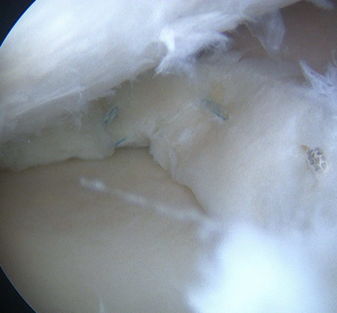 Meniscal Repair Inside Out